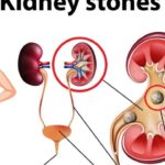 How To Sleep With A Kidney Stent