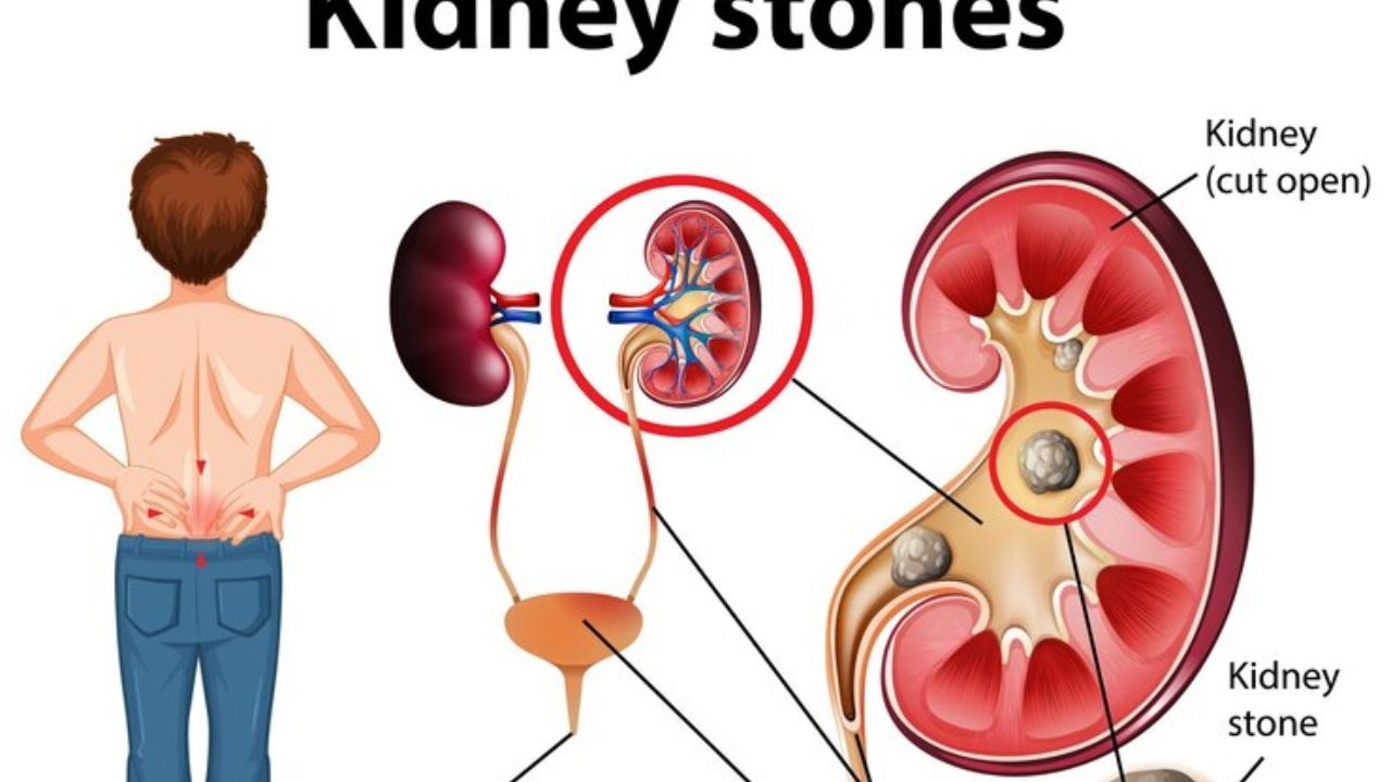 How To Sleep With A Kidney Stent