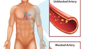 Fat Consumption on Heart Health