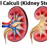 Would CBD Help With The Pain Of A Kidney Stone?