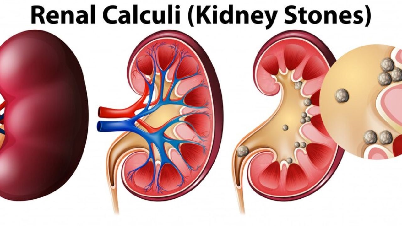 Would CBD Help With The Pain Of A Kidney Stone?