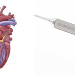 Can a loop recorder detect a heart attack