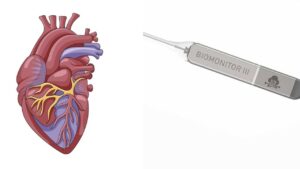 Can a loop recorder detect a heart attack