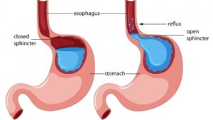 Can acid reflux cause heart palpitations?