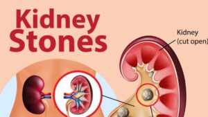 what foods cause kidney stones