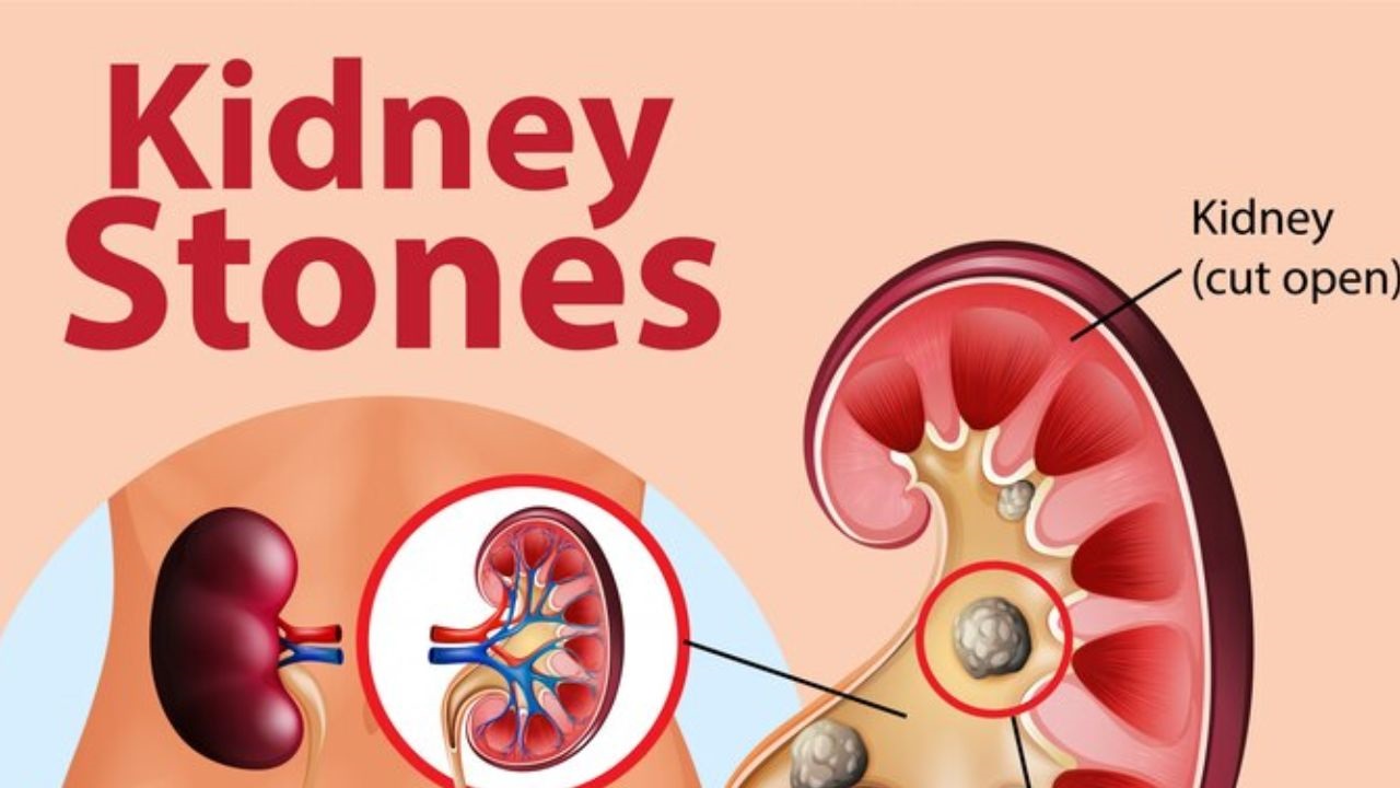 what foods cause kidney stones