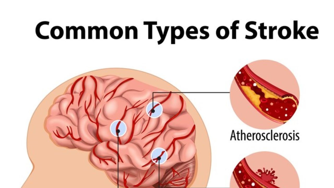 Are Strokes Genetic?